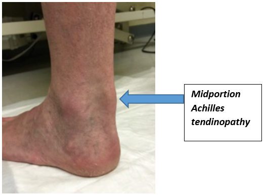 Achilles Tendinopathy Belfast Health Social Care Trust Website Achilles Tendinopathy Belfast Health Social Care Trust Website
