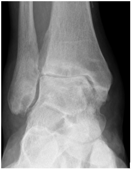 Osteoarthritis of the ankle: methods for joint-preservation