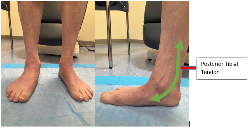 posterior tibial tendon diagram